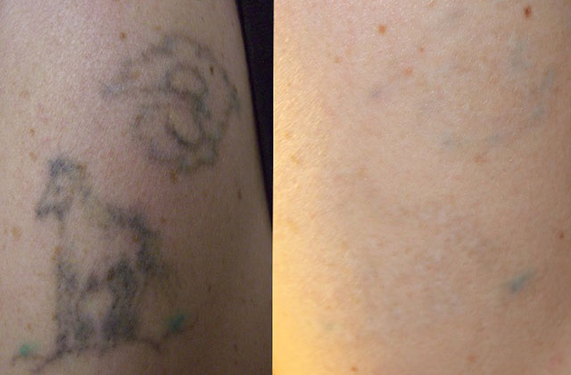 tattoo-before-after